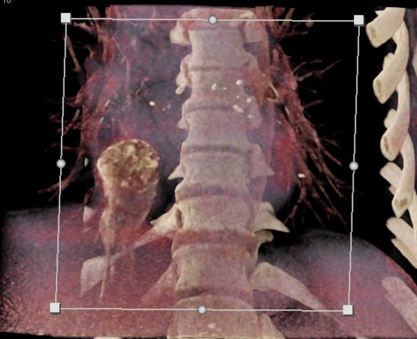 Tumor Extends into Heart from IVC - CTisus CT Scan