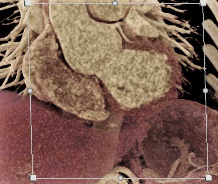 Dilated Aortic Root with CR - CTisus CT Scan