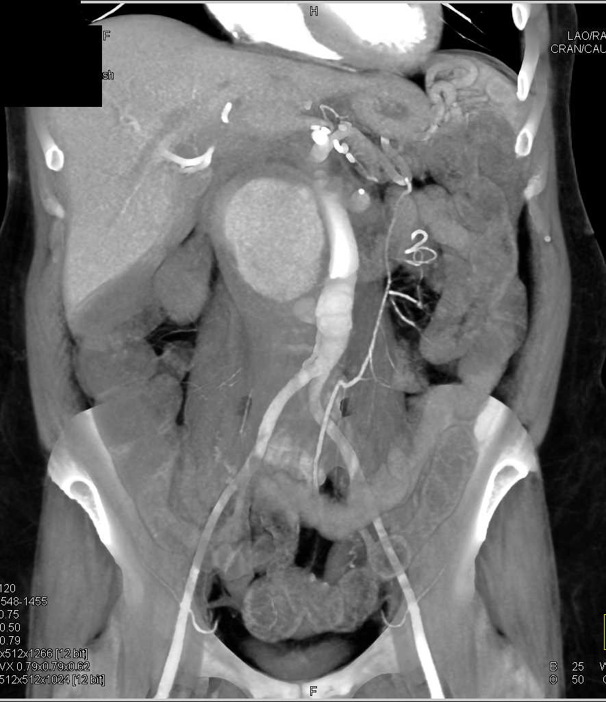Aortic Aneurysm with Renal Infarcts - CTisus CT Scan