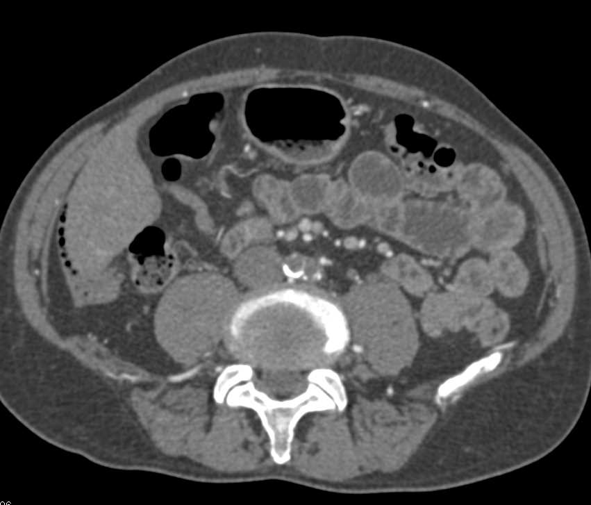 Occlusion Left Common Iliac Artery - CTisus CT Scan