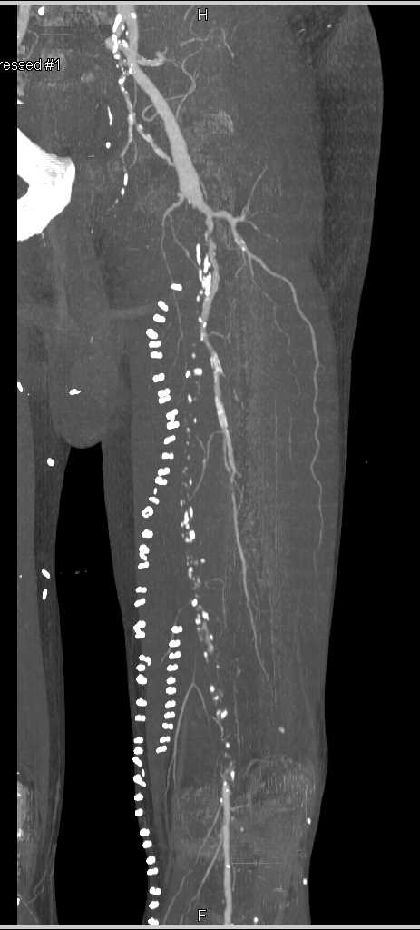 SFA Occlusion with Failed Grafts - CTisus CT Scan