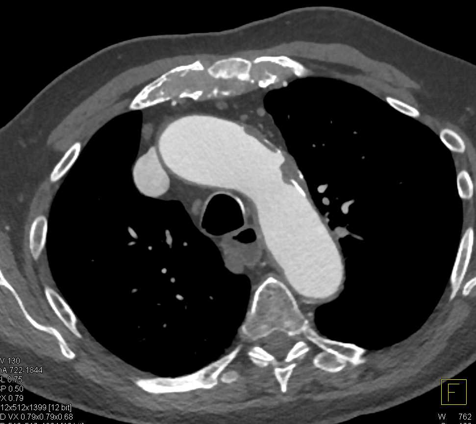 Endovascular Repair of Aortic Aneurysm - CTisus CT Scan