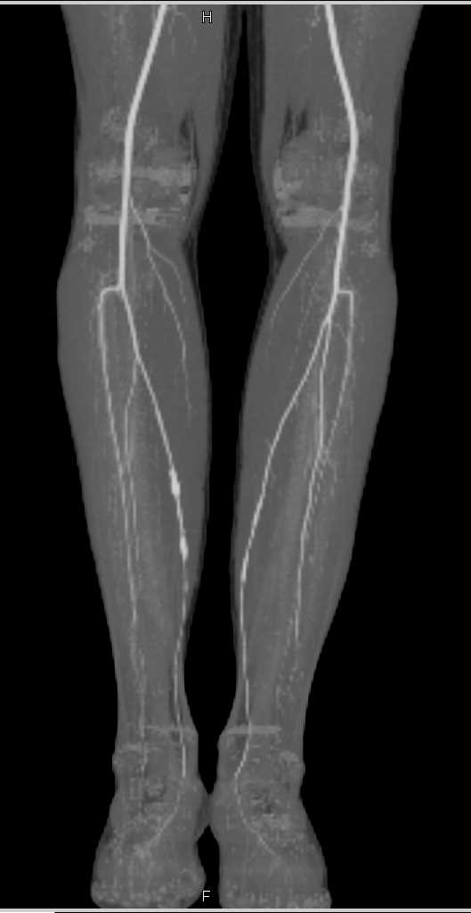 CTA Runoff with Mild PVD Lower Extremities - CTisus CT Scan