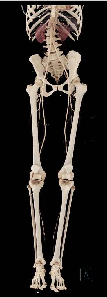 CTA runoff Study with Cinematic Rendering - CTisus CT Scan