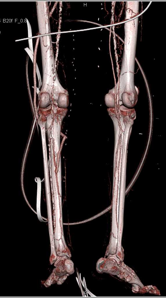 Femoral to Popliteal Artery Bypass Graft - CTisus CT Scan