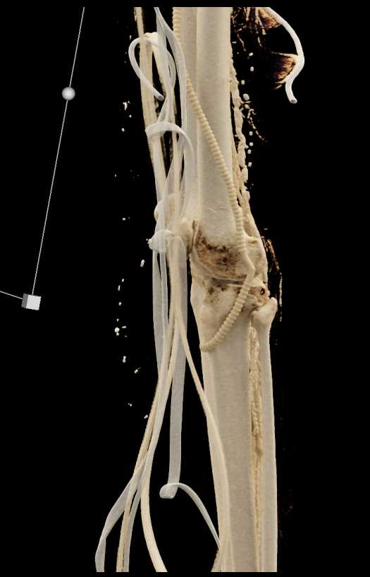 Femoral to Popliteal Artery Bypass Graft - CTisus CT Scan