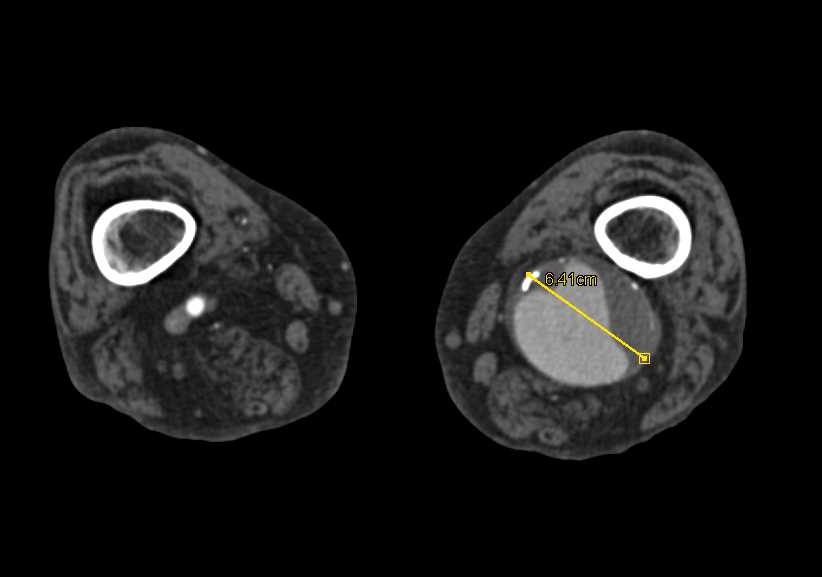 Popliteal Artery Aneurysm - CTisus CT Scan