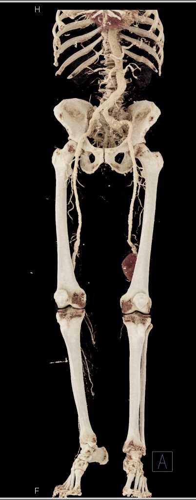 Popliteal Artery Aneurysm - CTisus CT Scan