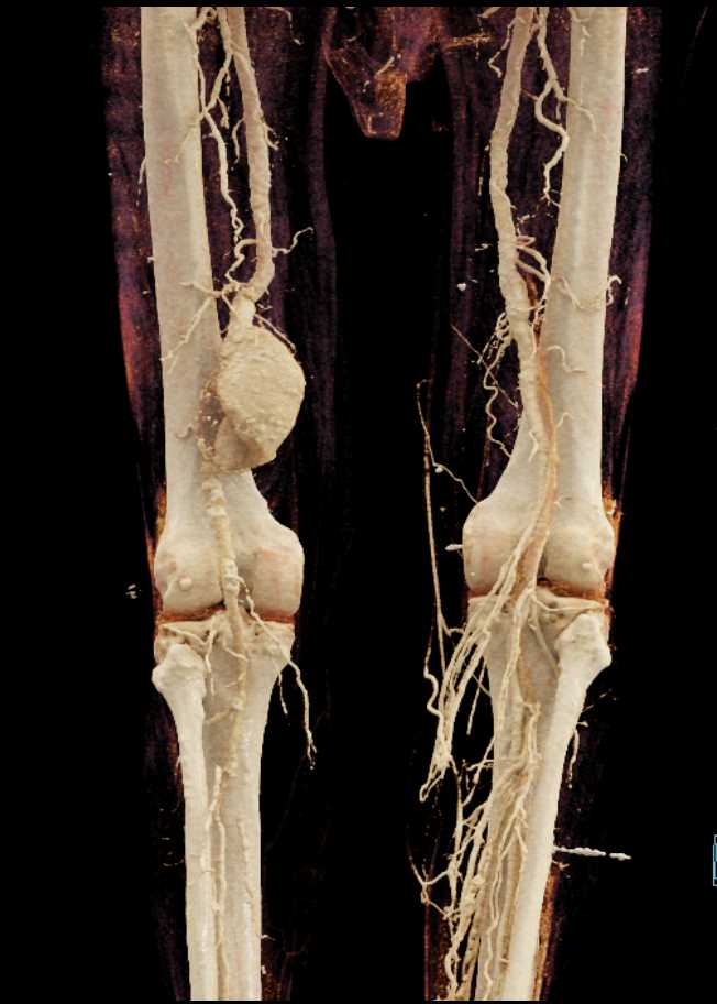 Popliteal Artery Aneurysm - CTisus CT Scan