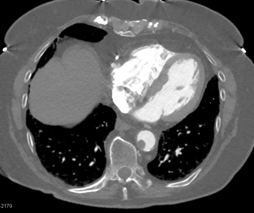 Clot in Aorta - CTisus CT Scan