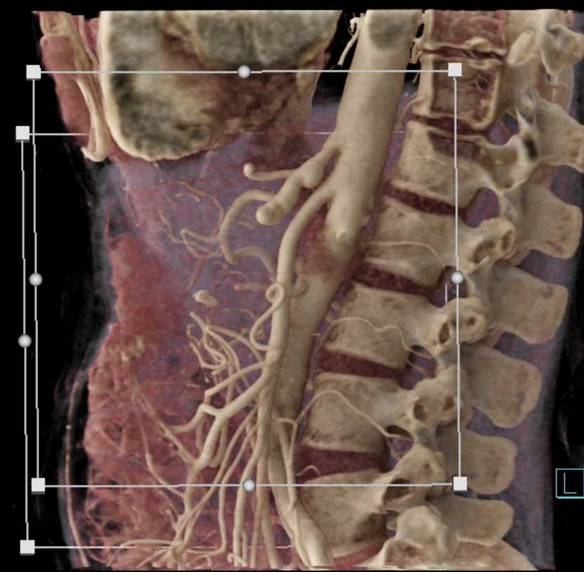 Cinematic Rendering of Vascular Arcade - CTisus CT Scan