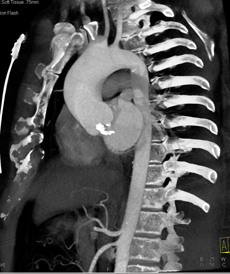 Extensive Aortic Valve Calcification - CTisus CT Scan