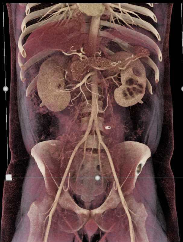 Renal Vein Thrombus and Renal Cell Carcinoma - CTisus CT Scan