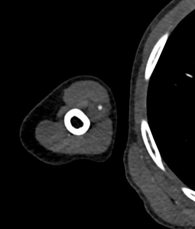 Pseudoaneurysm Brachial Artery - CTisus CT Scan