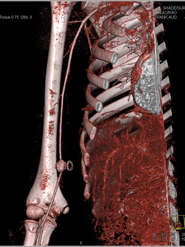 Pseudoaneurysm Brachial Artery - CTisus CT Scan