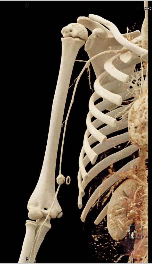 Pseudoaneurysm Brachial Artery - CTisus CT Scan