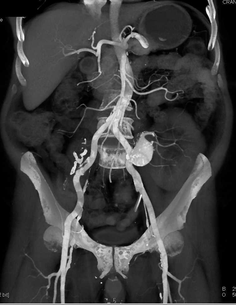 Renal Artery Aneurysm - CTisus CT Scan