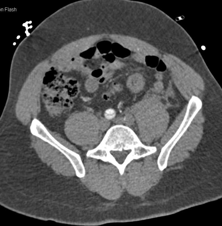 Dissection Lower Abdominal Aorta - CTisus CT Scan