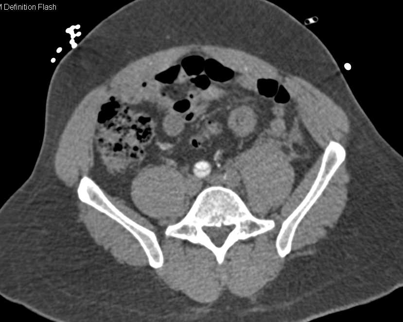 Dissection Lower Abdominal Aorta Extending Into Left Common Iliac Artery - CTisus CT Scan