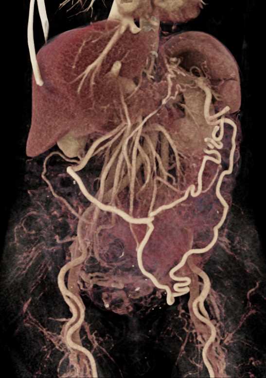 Adenocarcinoma Body of Pancreas with Vascular Encasement and Occlusion with Collaterals - CTisus CT Scan