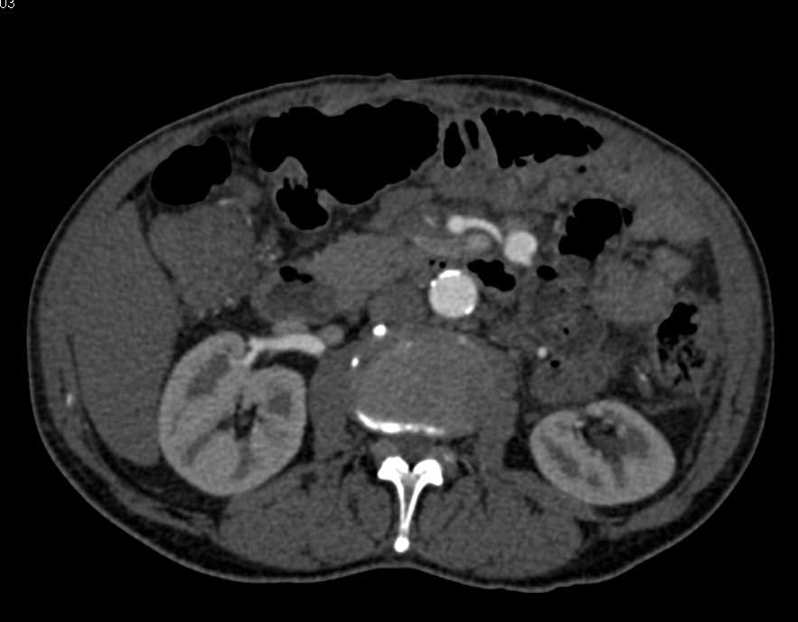 Aneurysm off the Jejunal Branch of the SMA - CTisus CT Scan