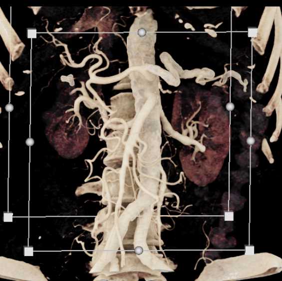 SMA and Celiac Artery Branching - CTisus CT Scan