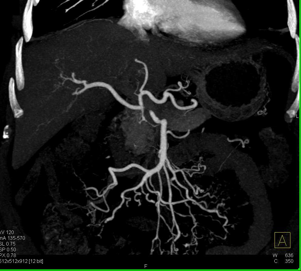 Vasculitis Involves the SMA - CTisus CT Scan