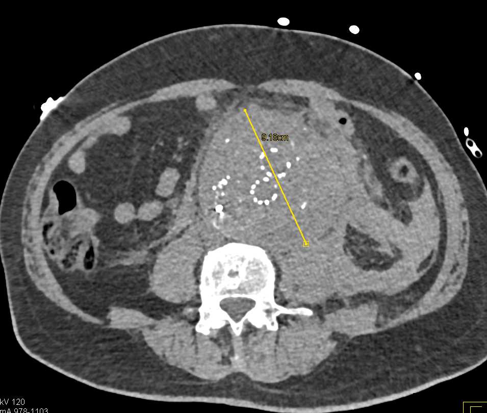 Leaking Abdominal Aortic Aneurysm with EVAR - CTisus CT Scan