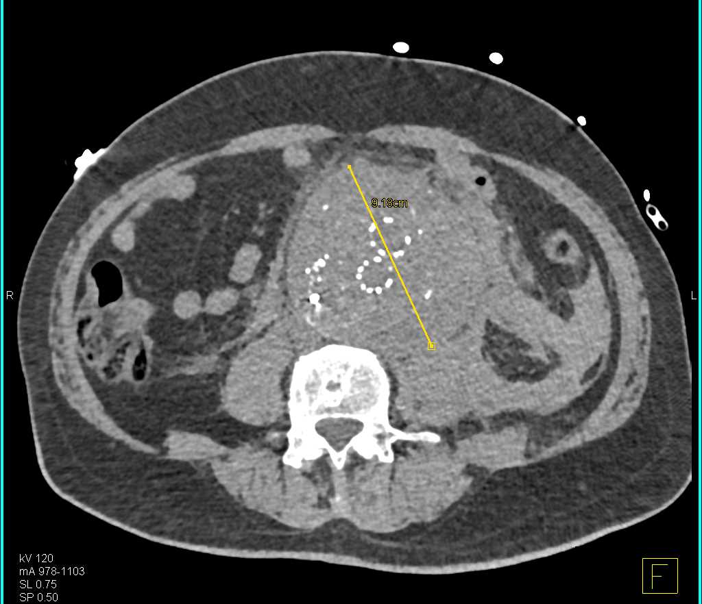 Leaking Abdominal Aortic Aneurysm with EVAR - CTisus CT Scan