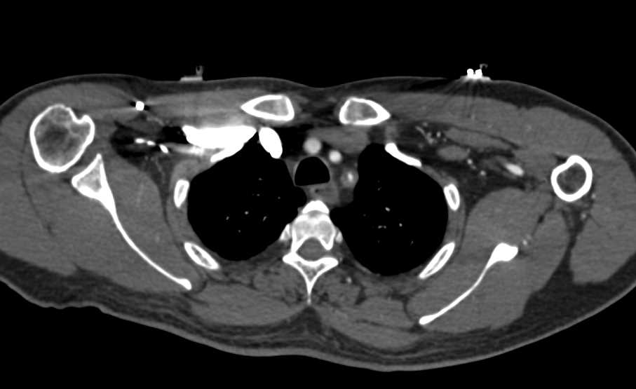 Takayasu Aortitis Involves the Left Subclavian Artery - CTisus CT Scan