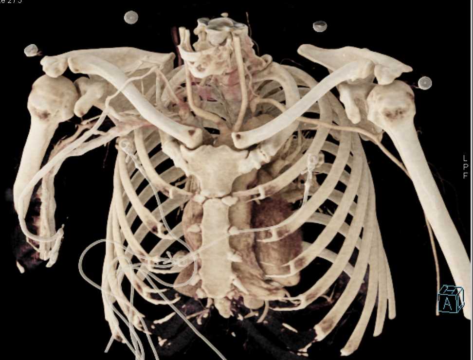 Takayasu's Aortitis Involves the Left Subclavian Artery - CTisus CT Scan