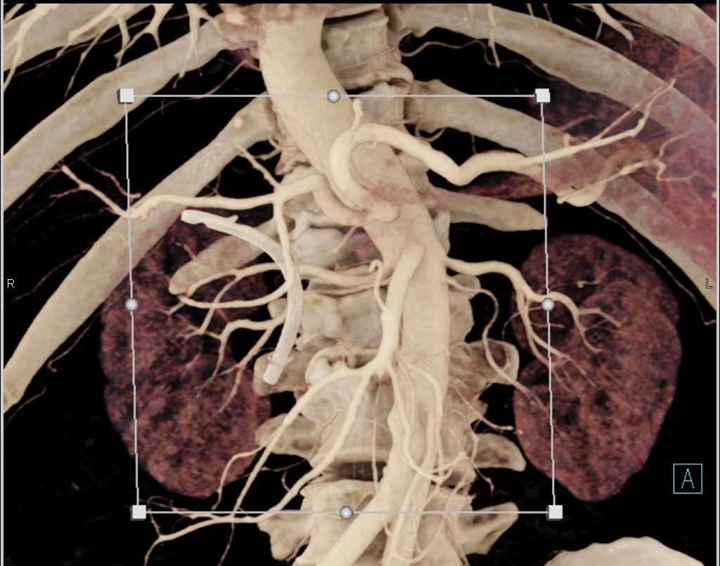 Stent in the Common Bile Duct (CBD) with Vascular Map - CTisus CT Scan