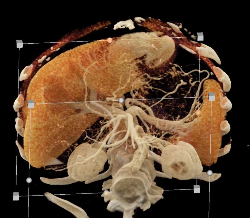 Pancreatic Cancer with Stent in the Common Bile Duct (CBD) with Vascular Map - CTisus CT Scan