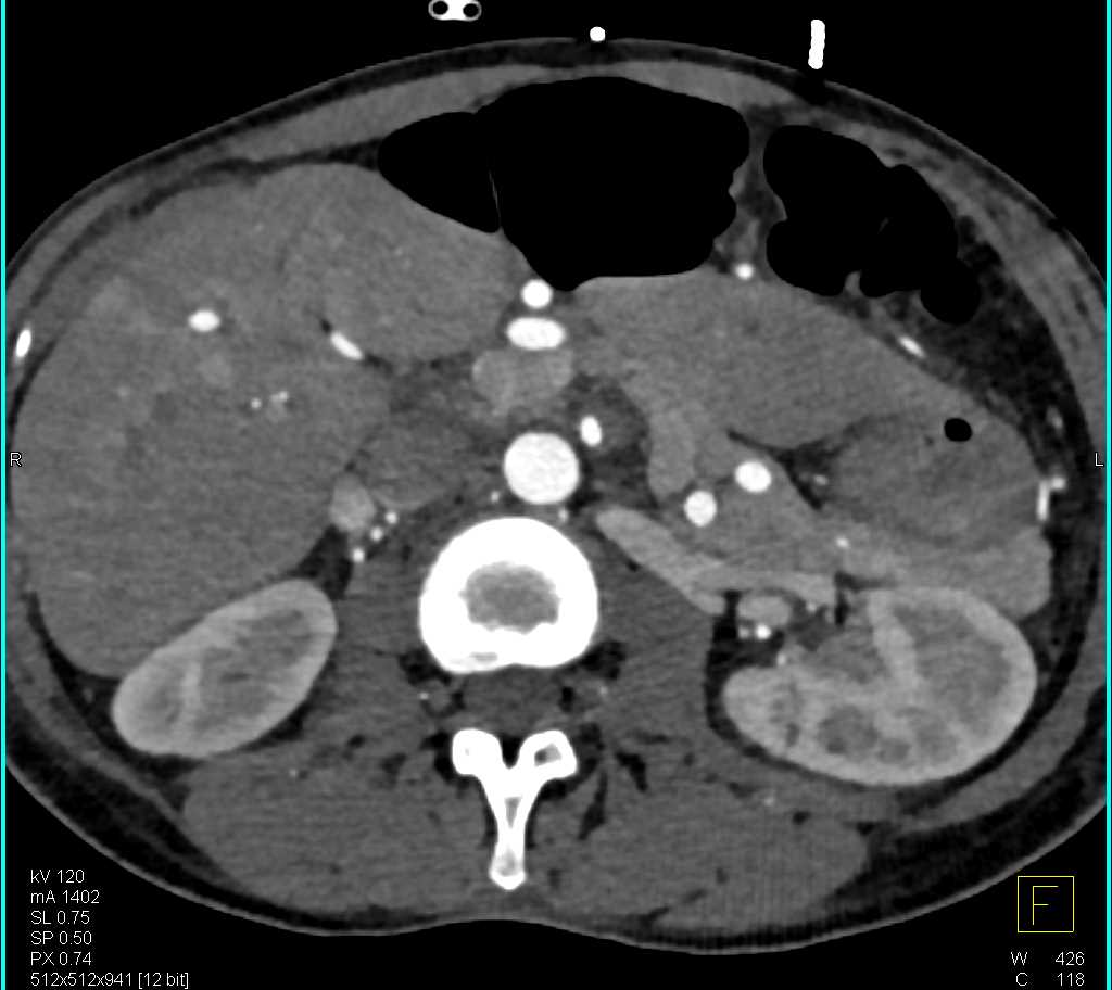 Vasculitis Especially of Superior Mesenteric Artery (SMA) Branches - CTisus CT Scan