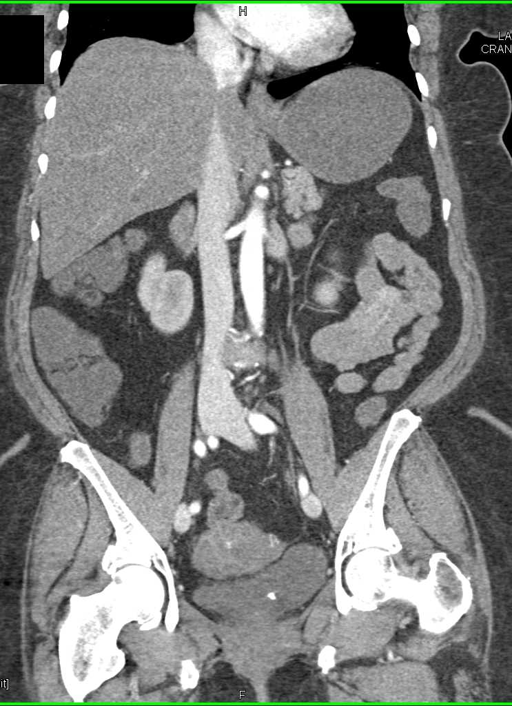 Inferior Vena Cava (IVC) Branching - CTisus CT Scan