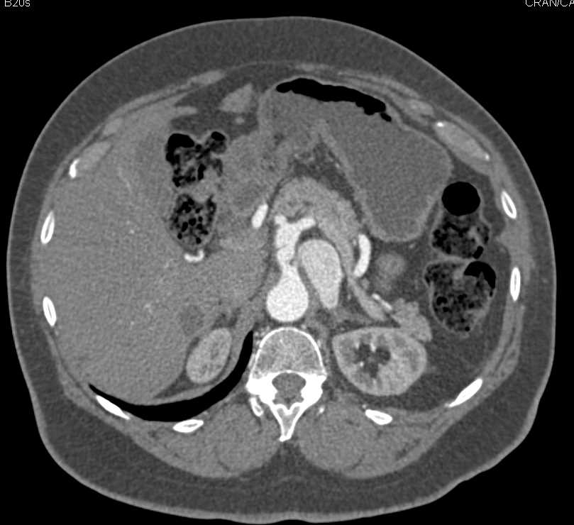 Focal Dissection in the Celiac Artery - CTisus CT Scan