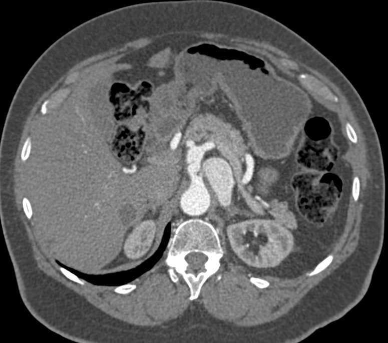 Focal Dissection in the Celiac Artery and Vascular Anomaly - CTisus CT Scan