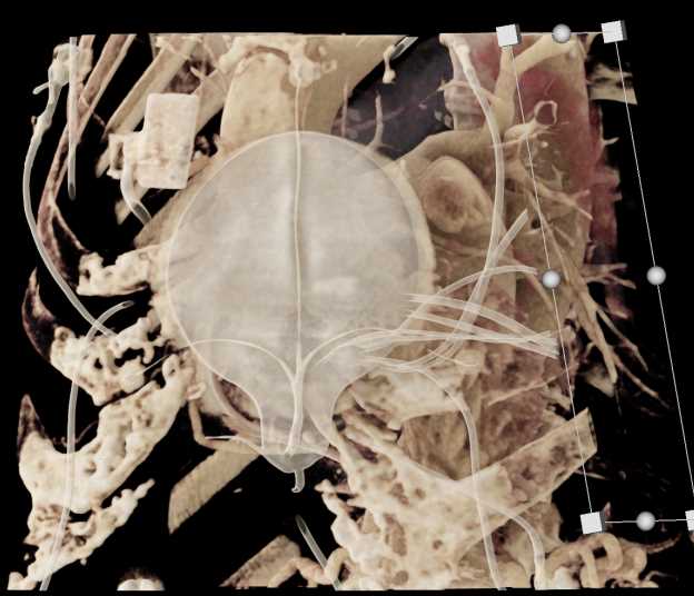 Post TAVR Changes Aortic Valve with CR - CTisus CT Scan