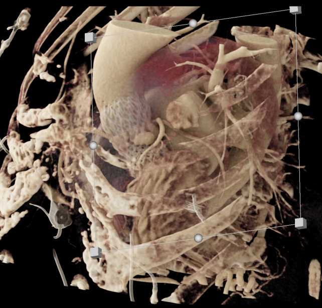 Post TAVR Changes Aortic Valve with CR - CTisus CT Scan