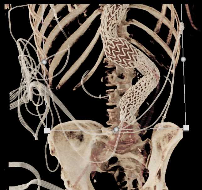 Endovascular Stent Repair with Bypass Grafts - CTisus CT Scan