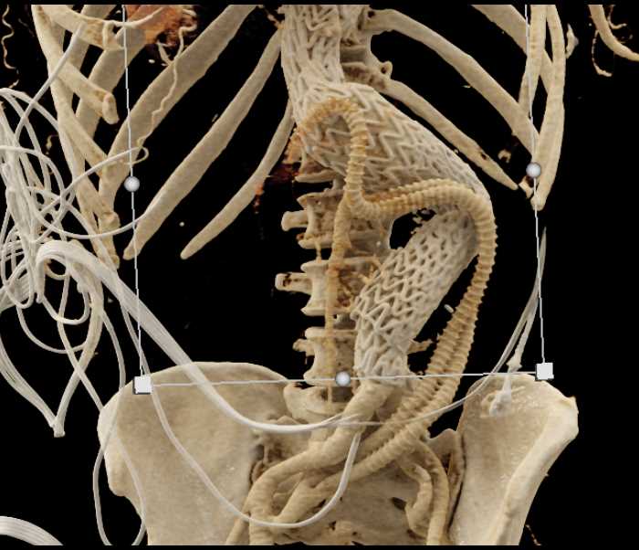 Endovascular Stent Repair with Bypass Grafts - CTisus CT Scan