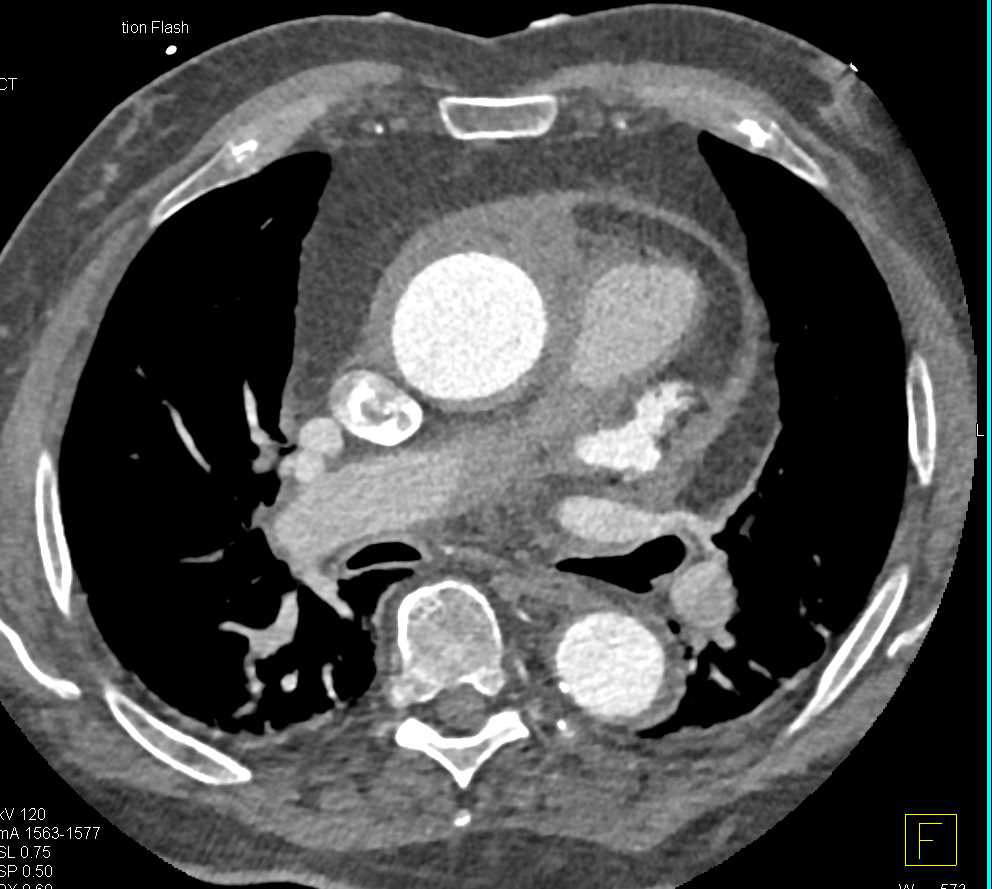 Focal Aortic Dissection - CTisus CT Scan