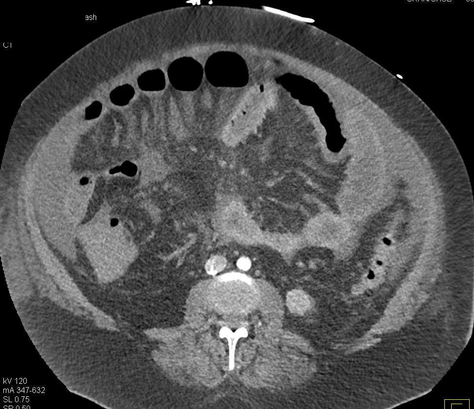 Carcinomatosis with IVC Clot - CTisus CT Scan