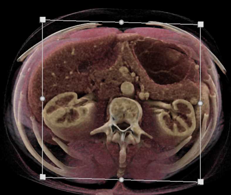 Dilated Left Gonadal Vein - CTisus CT Scan