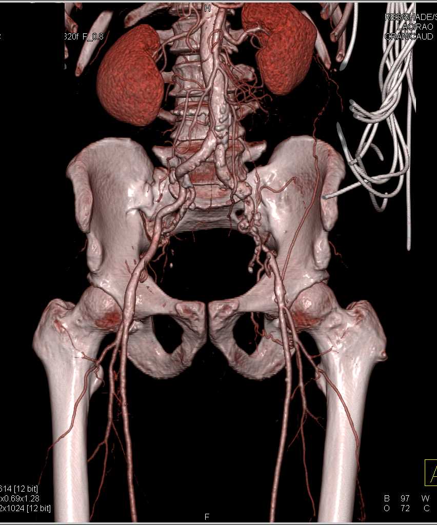 PAD with Occluded Left Iliac Artery - CTisus CT Scan