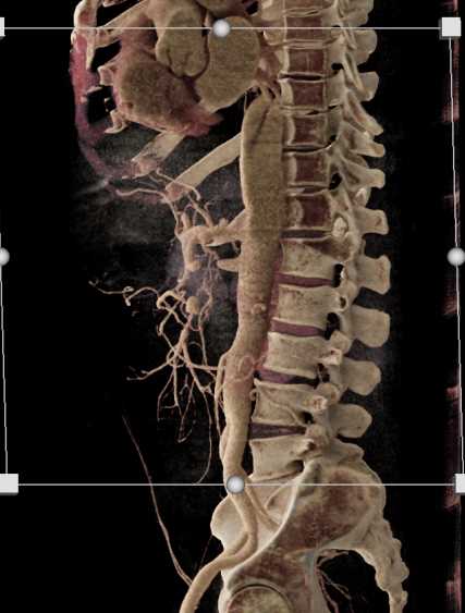 Celiac Artery Branching - CTisus CT Scan