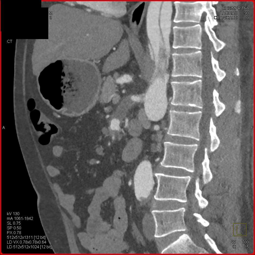 SMA Dissection and Occlusion - CTisus CT Scan