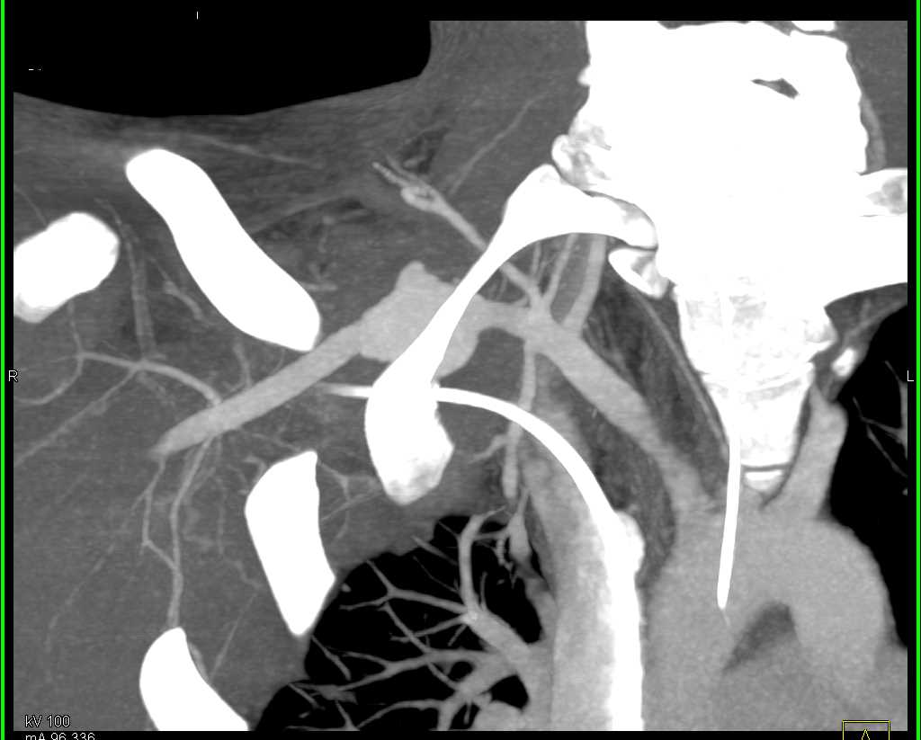 Axillary Artery Pseudoaneurysm - CTisus CT Scan