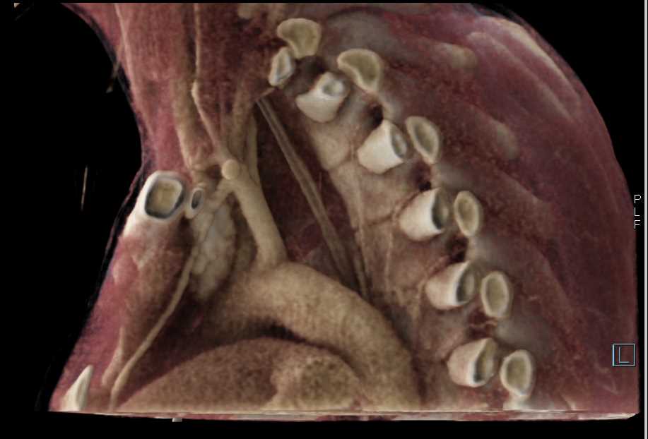 Axillary Artery Pseudoaneurysm - CTisus CT Scan