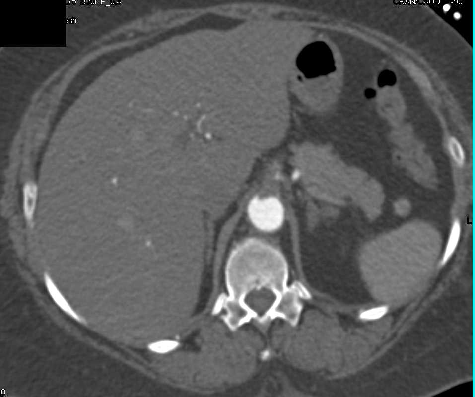 PAD with Occlusion Best Seen n the SFA's Bilaterally - CTisus CT Scan